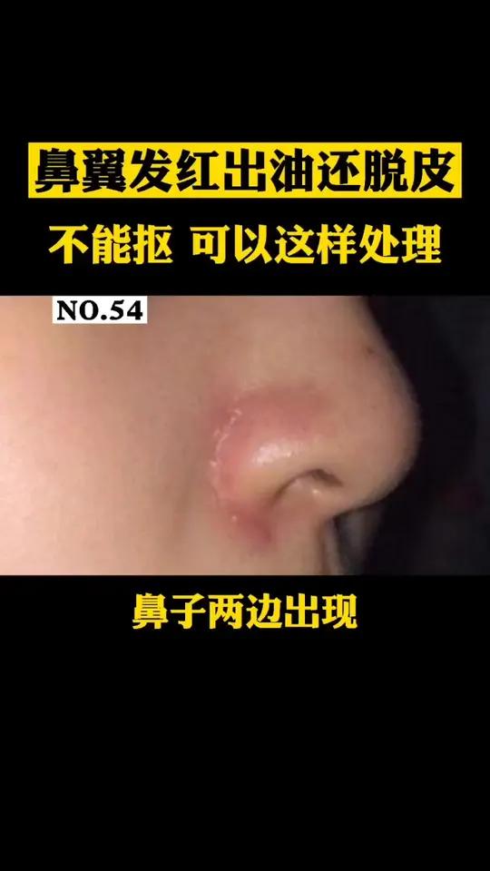 鼻子两边发红怎么回事