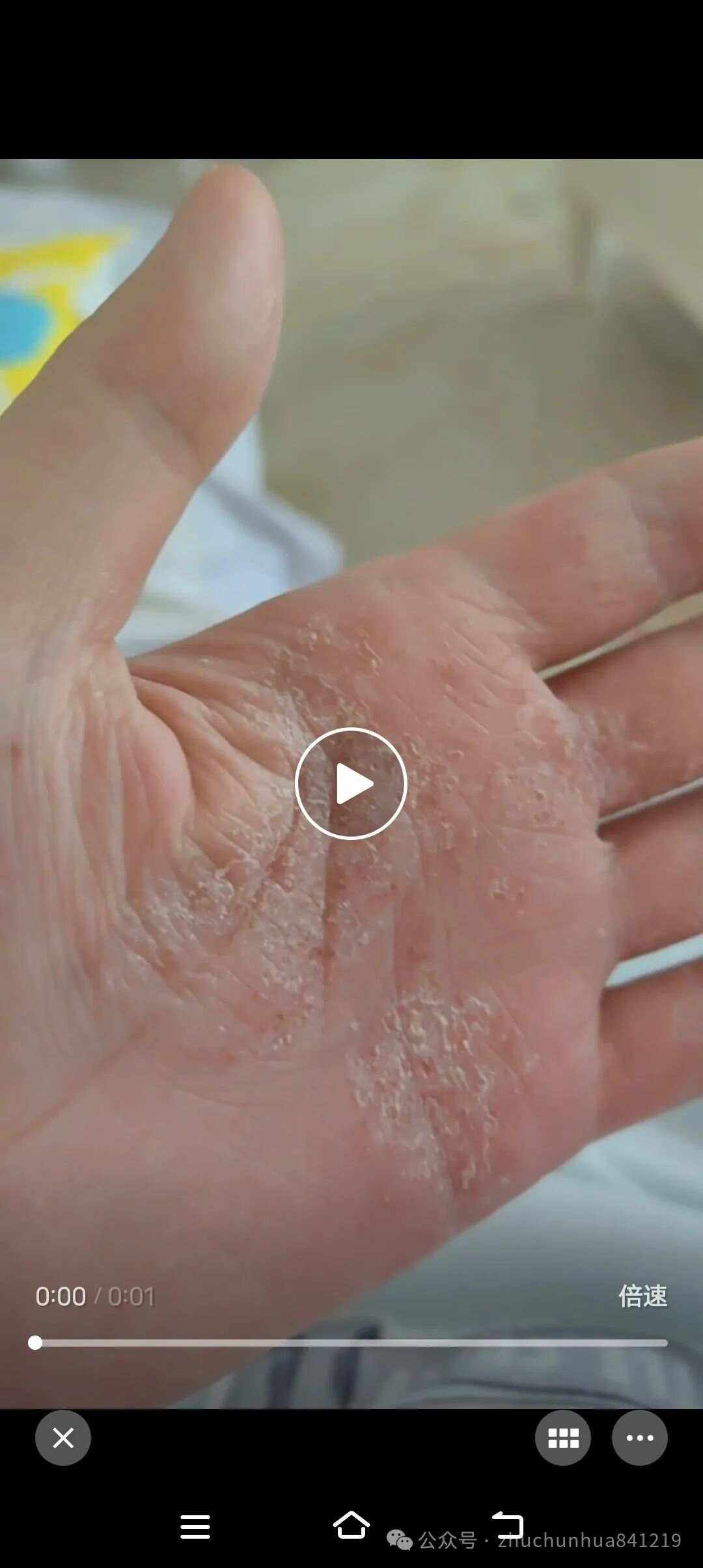 如何治疗手癣
