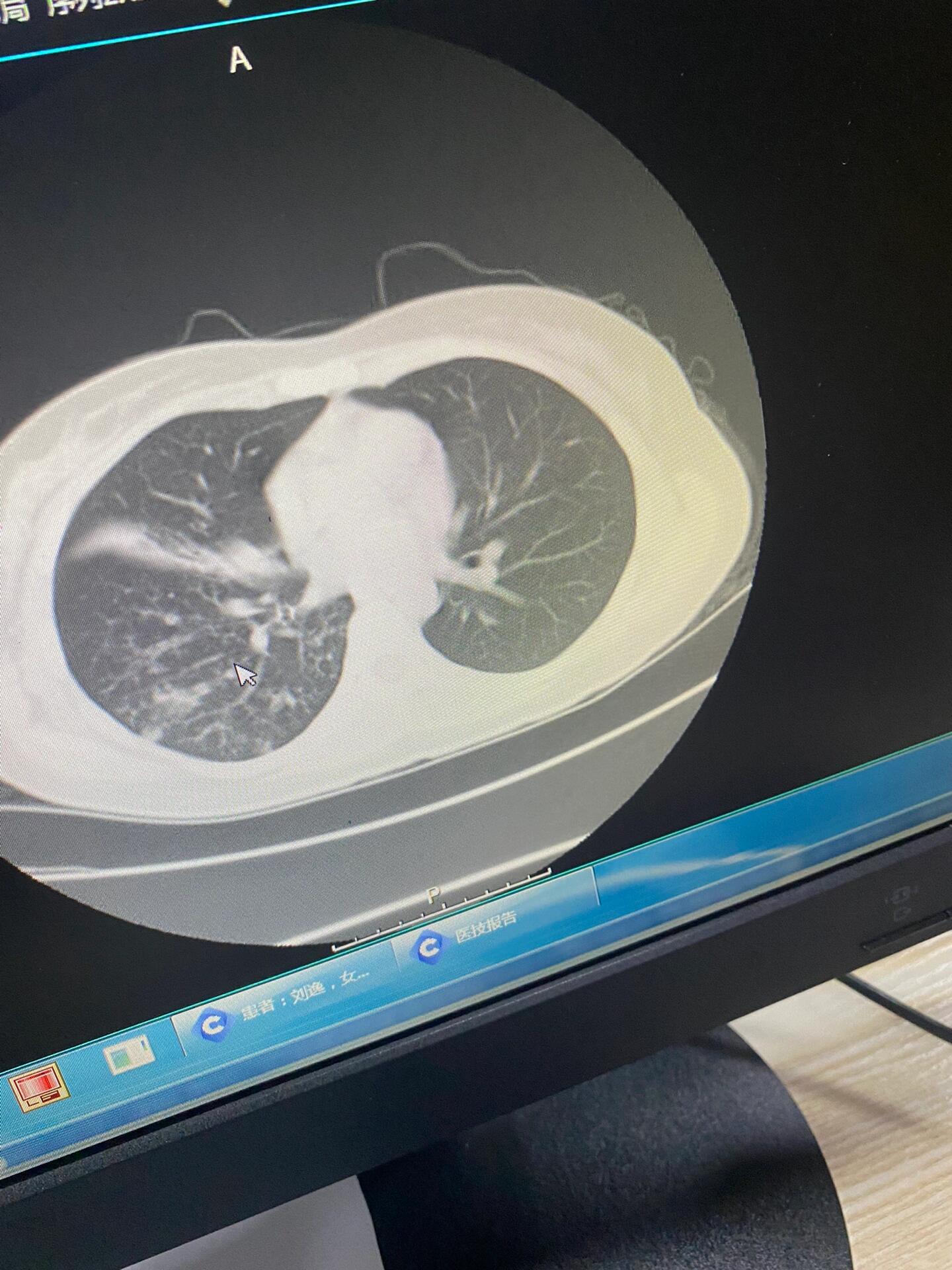 肺结核空洞严重吗