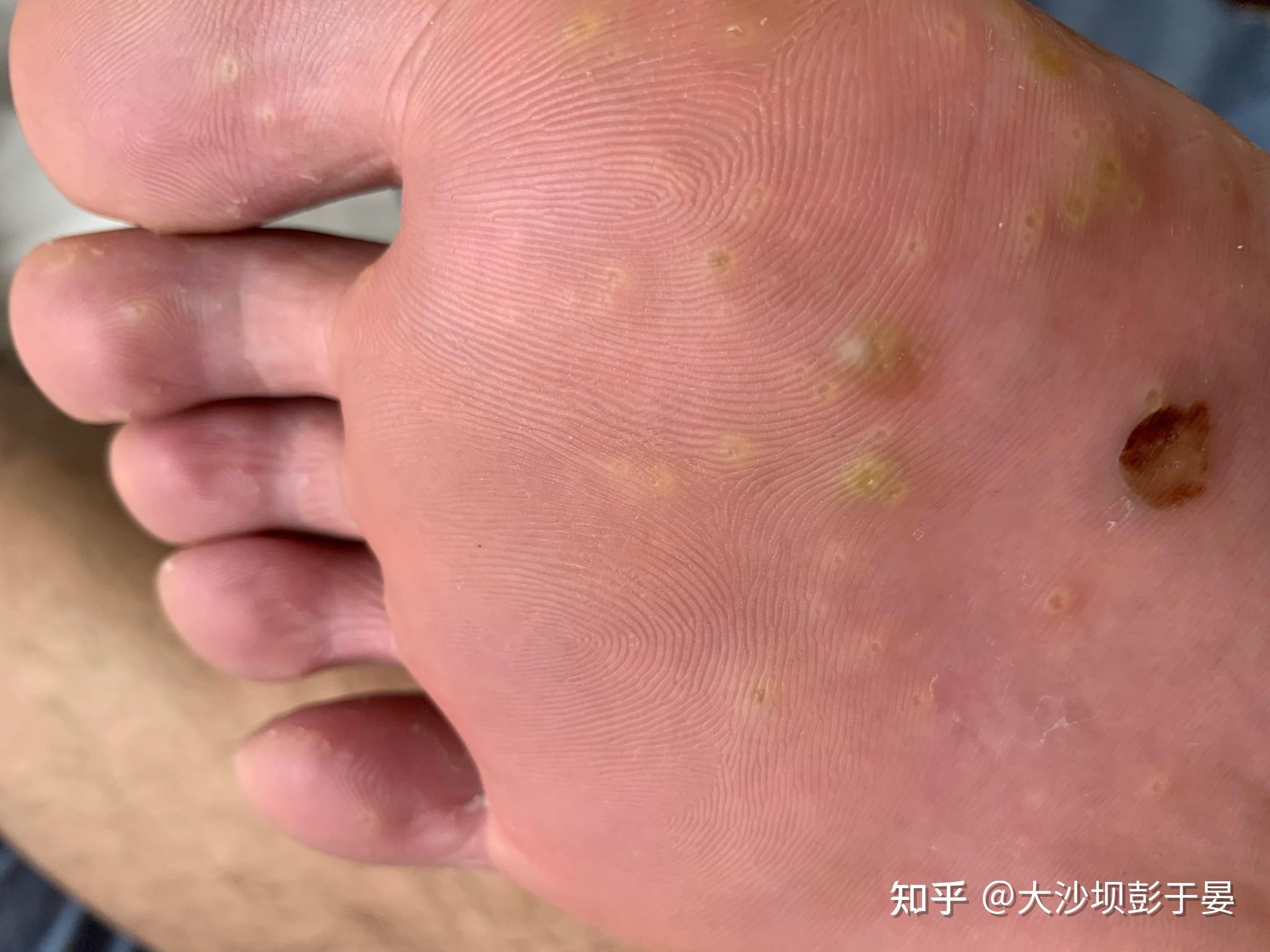 脚上长的不知道什么东西
