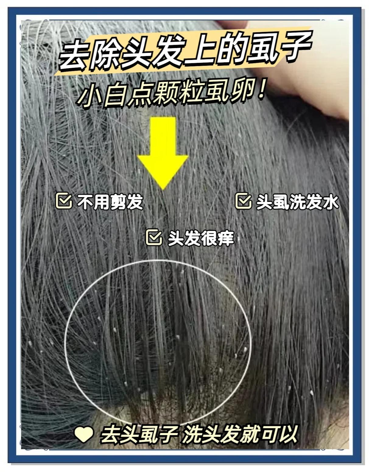头虱会留在枕头上吗