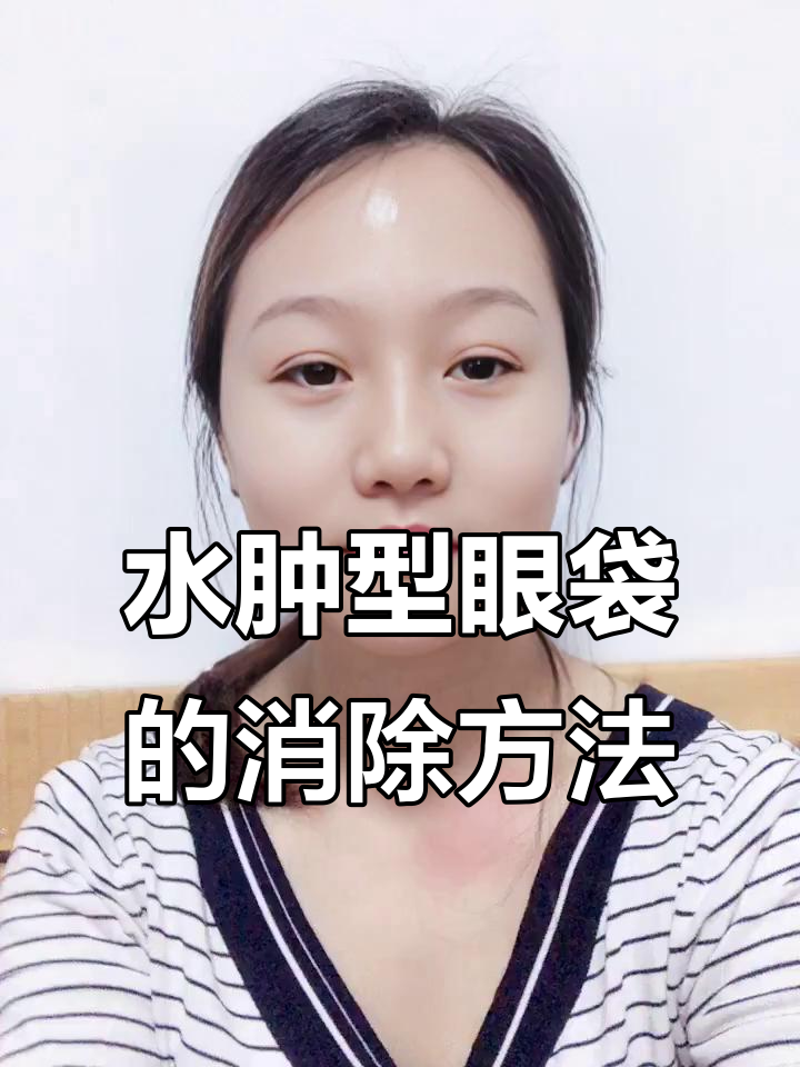 眼袋水肿怎么办?