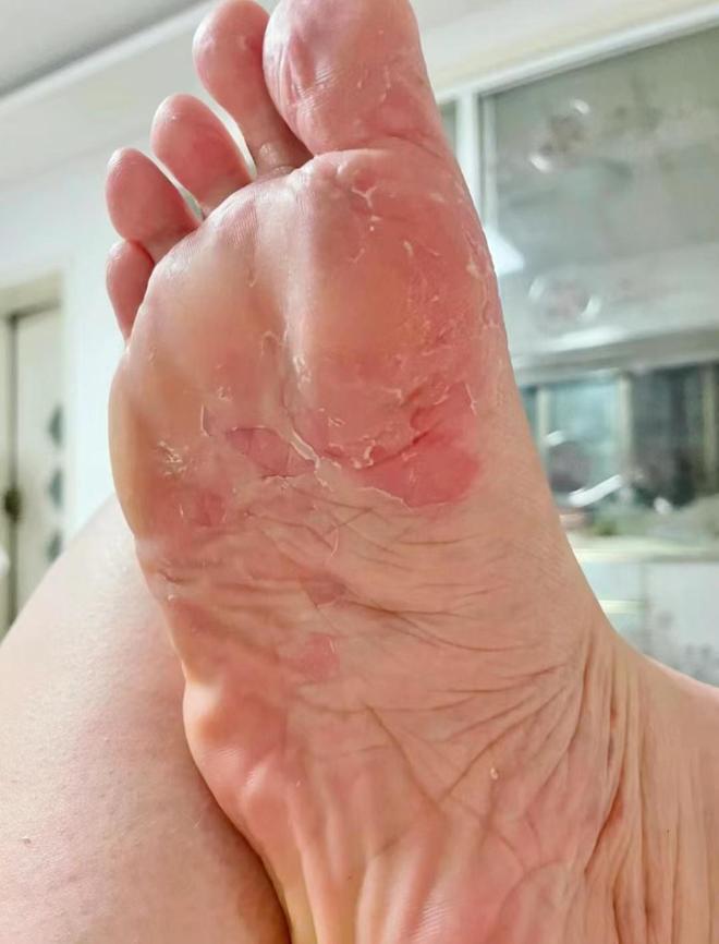 男足球运动员,有脚气,汗脚,脚特别臭