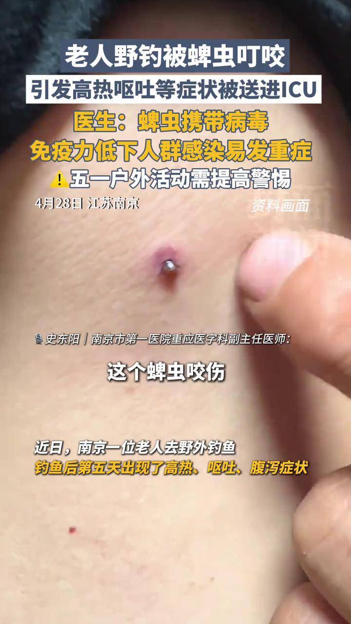 草爬子咬后什么症状