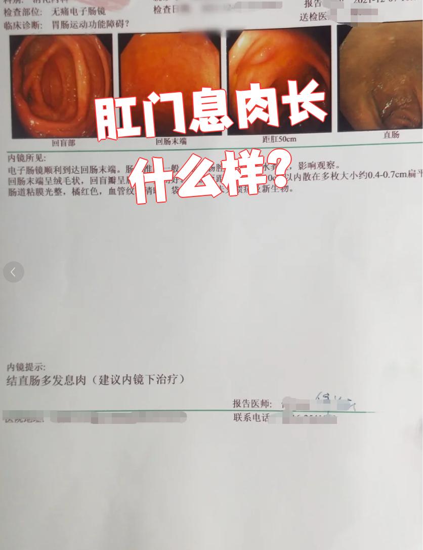 肛门旁边长了个硬硬的包