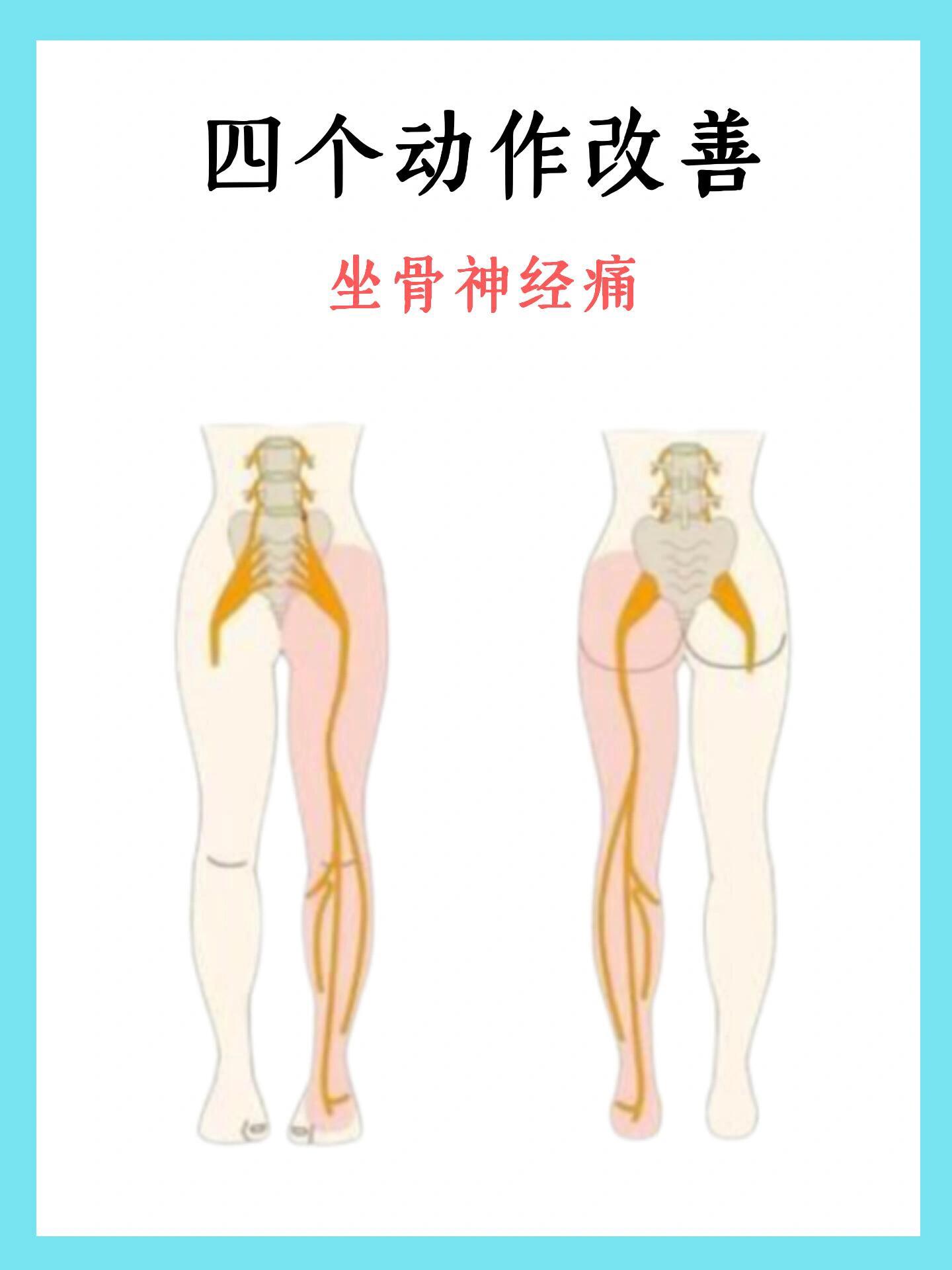 坐骨神经痛的症状表现