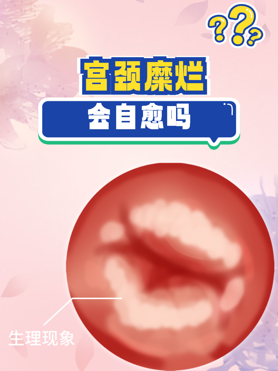 轻微宫颈糜烂怎么回事