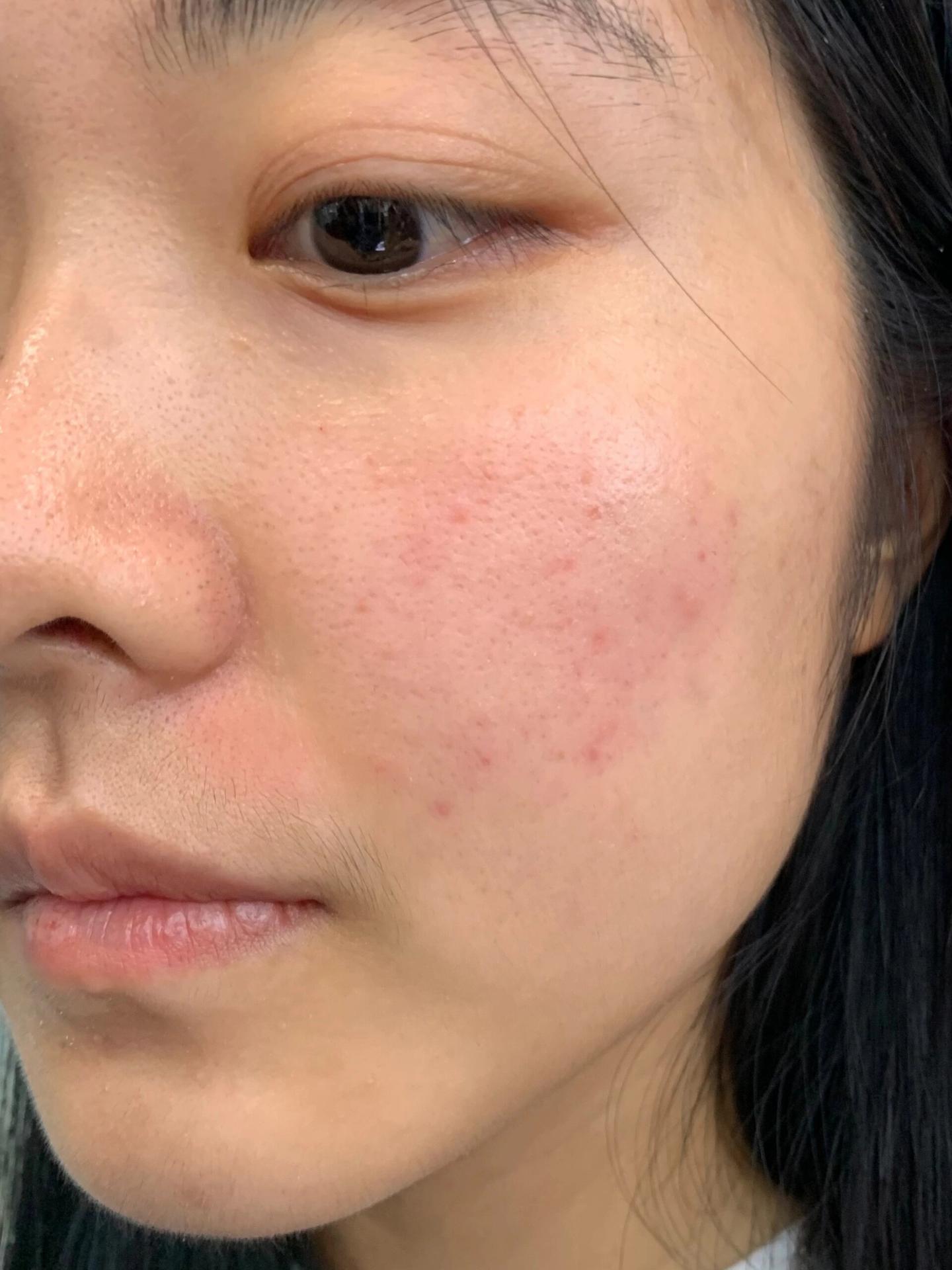 脸上长好多痘痘(如下图