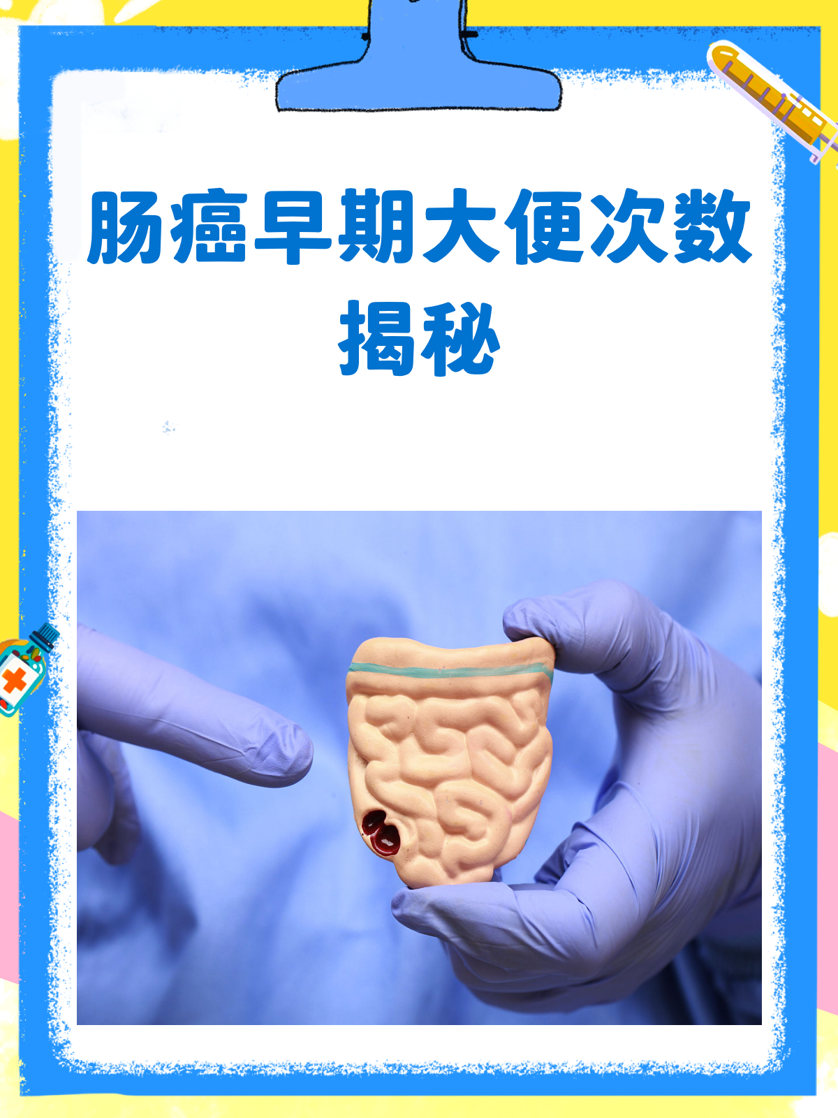 大便次数多还不成形是直肠癌吗