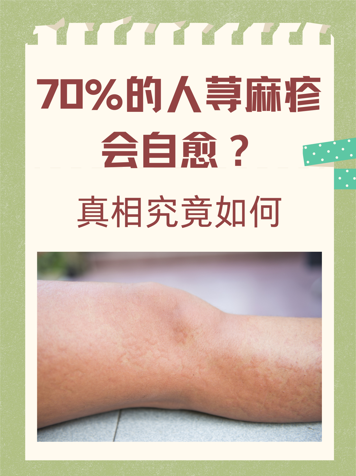 麻疹传染吗