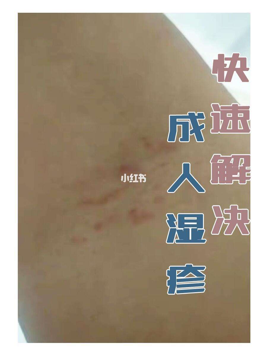 成人湿疹最好的治疗方法是什么?