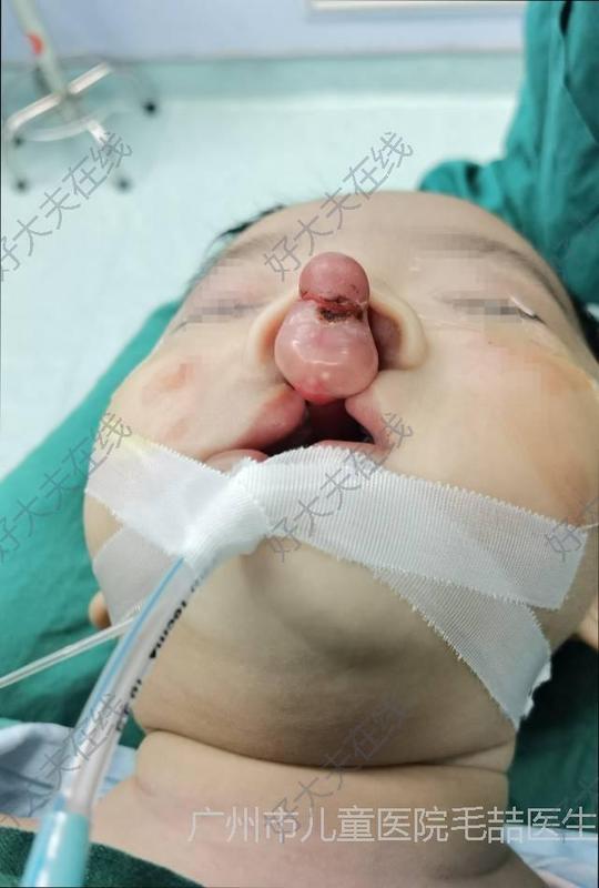 先天性唇腭裂是什么病