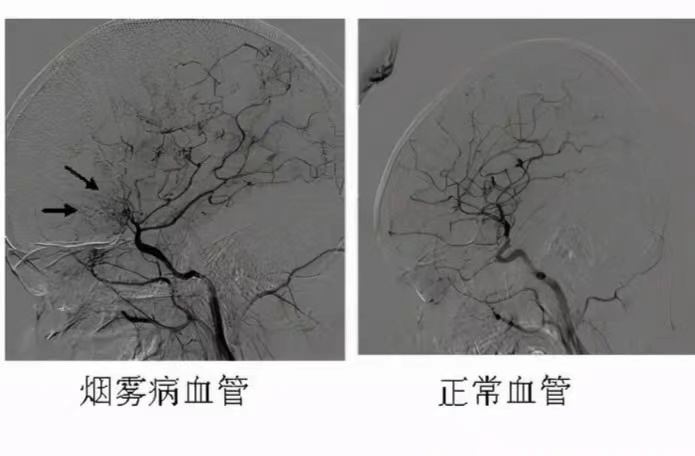 烟雾病可以治愈吗