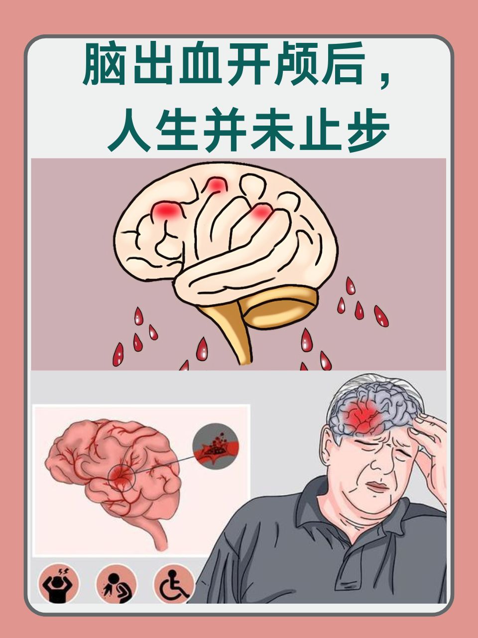 脑溢血的治疗