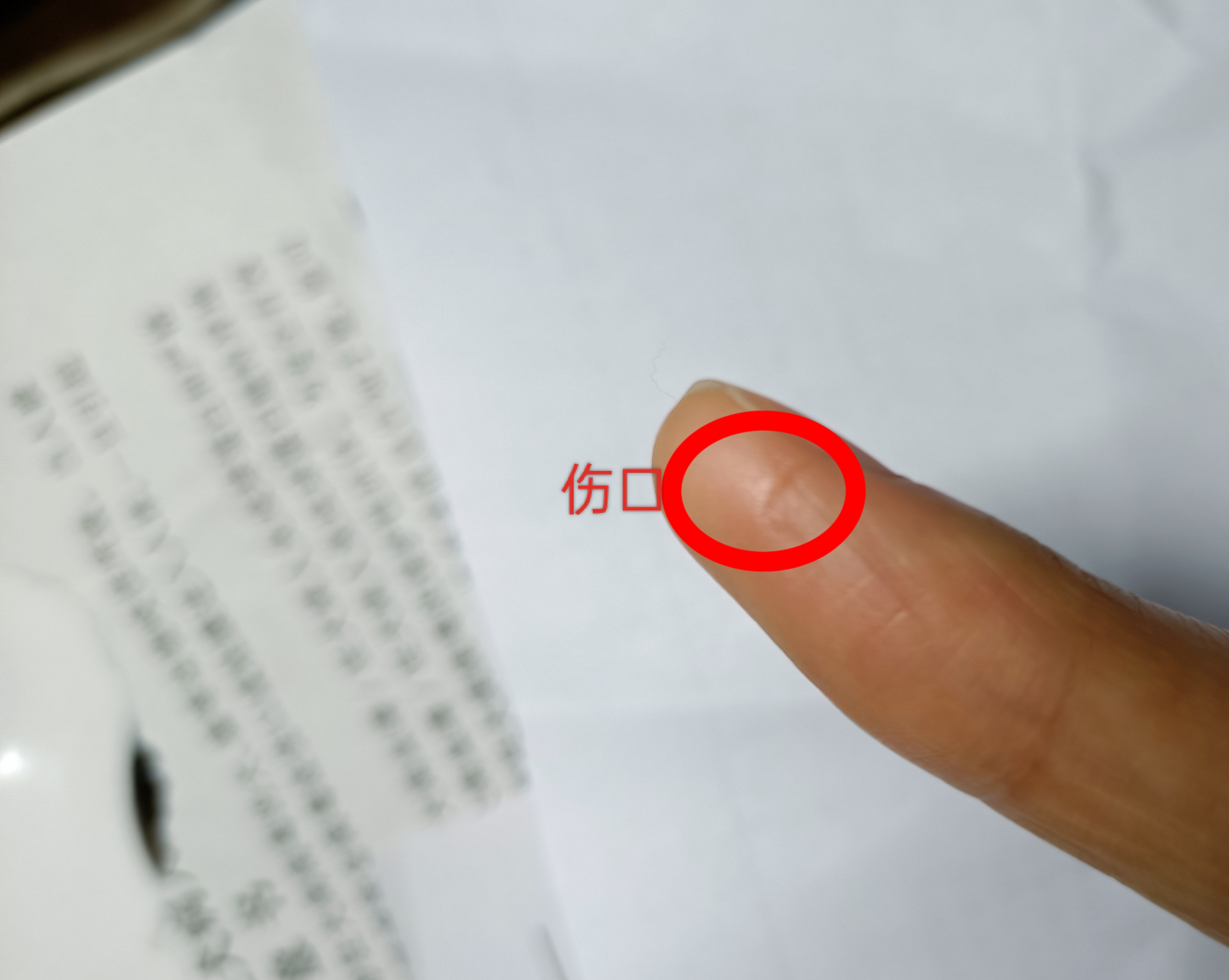 被老鼠咬了怎么办