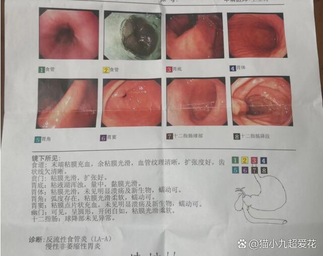 胆汁反流性胃炎严重吗