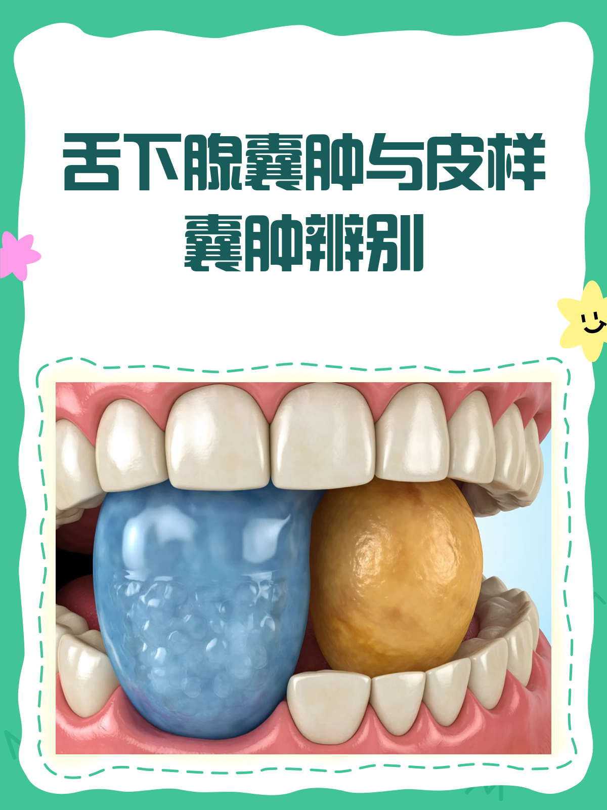 舌下腺囊肿会癌变吗、?