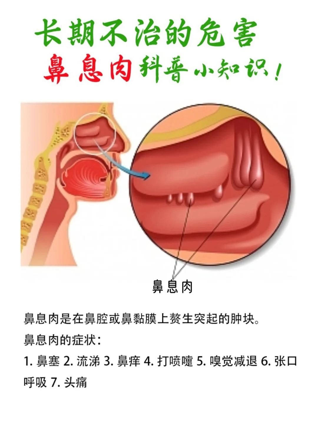 鼻息肉严重吗
