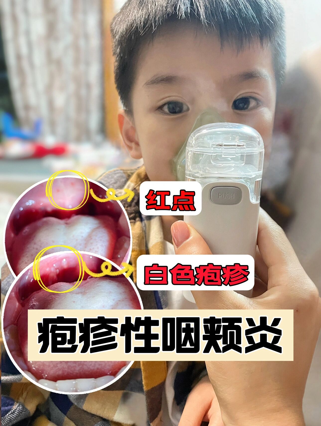 宝宝喉炎的症状有哪些