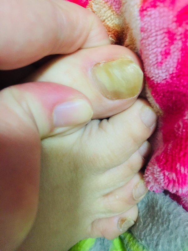 脚趾甲变厚发黄是怎么回事?