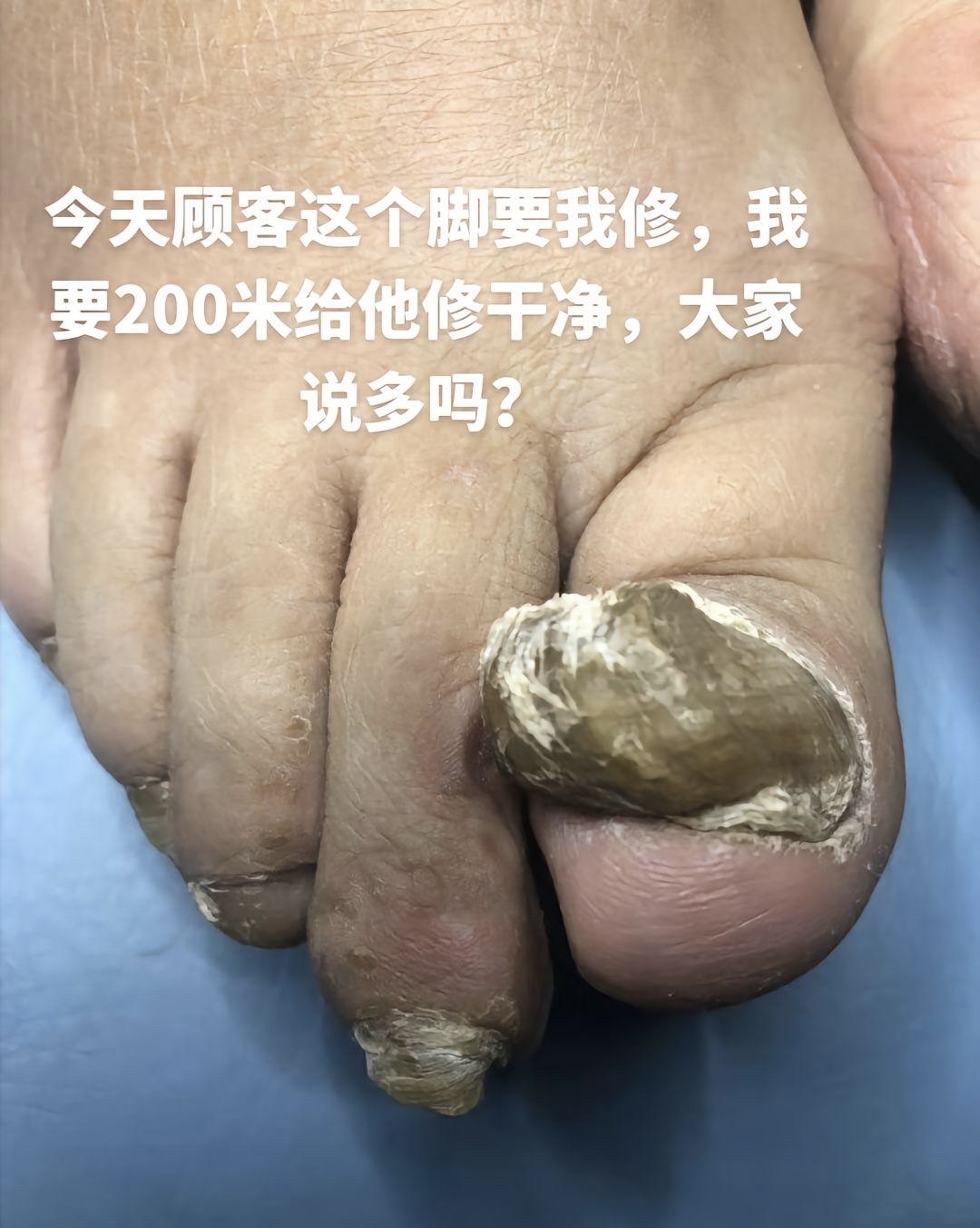 脚趾甲变厚发黄是怎么回事?