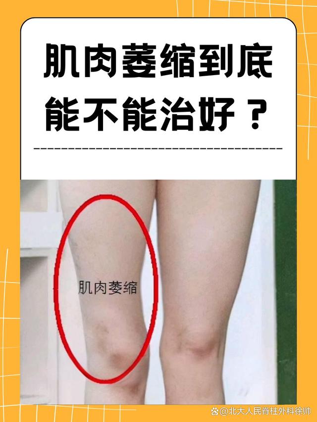 什么是肌萎缩侧索硬化症