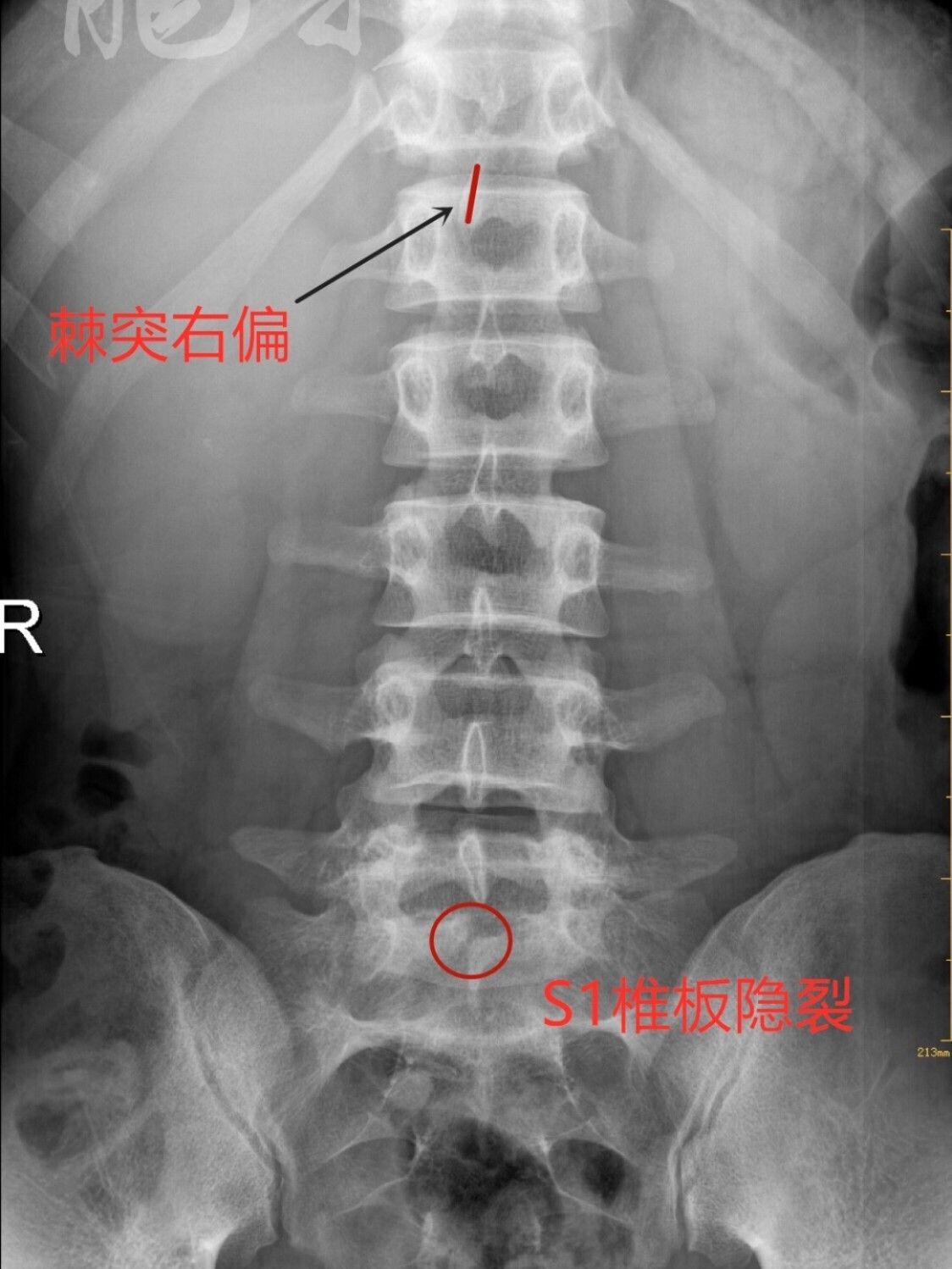 隐性脊柱裂能治愈吗?