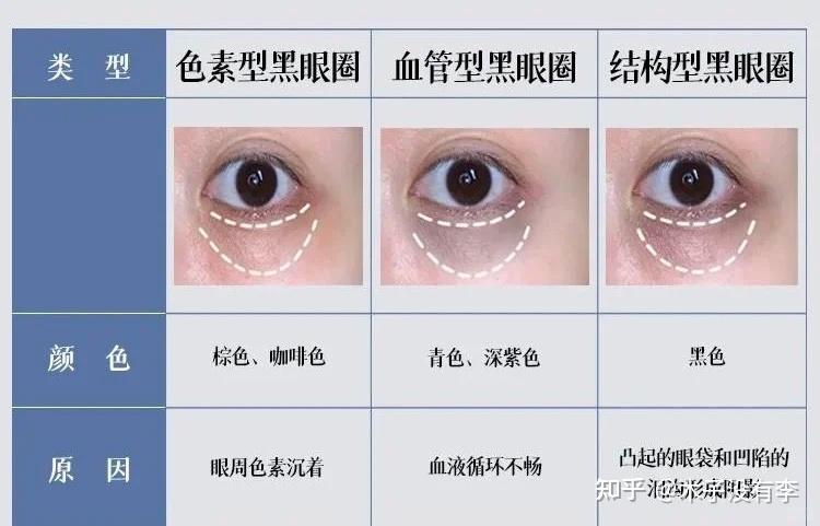 眼圈发黑是怎么回事