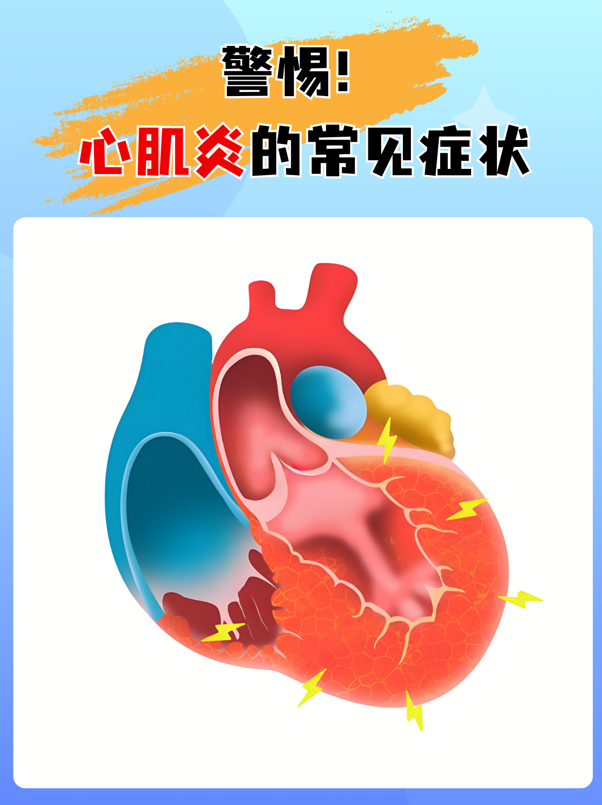扩张性心肌炎