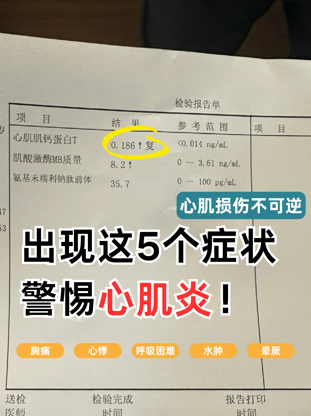 扩张性心肌炎