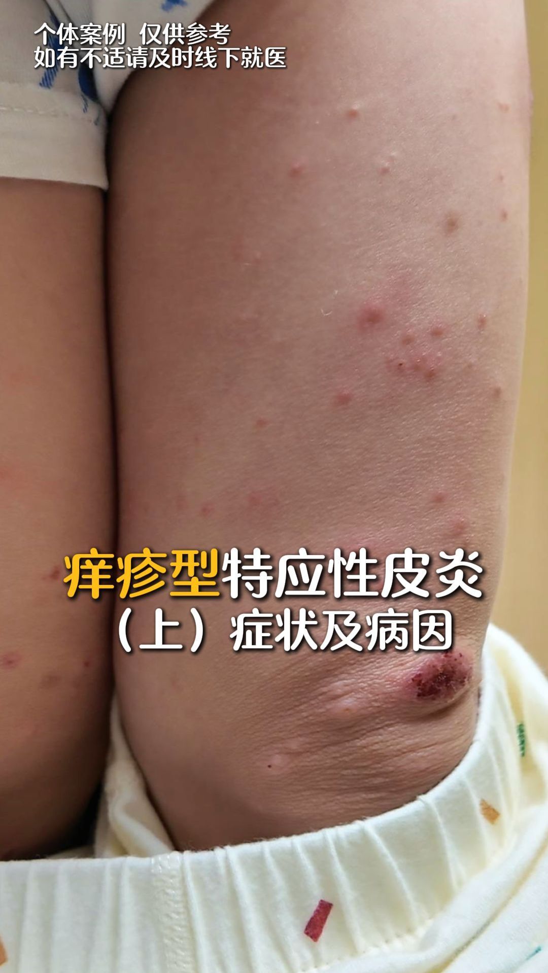 特应性皮炎能治好吗?