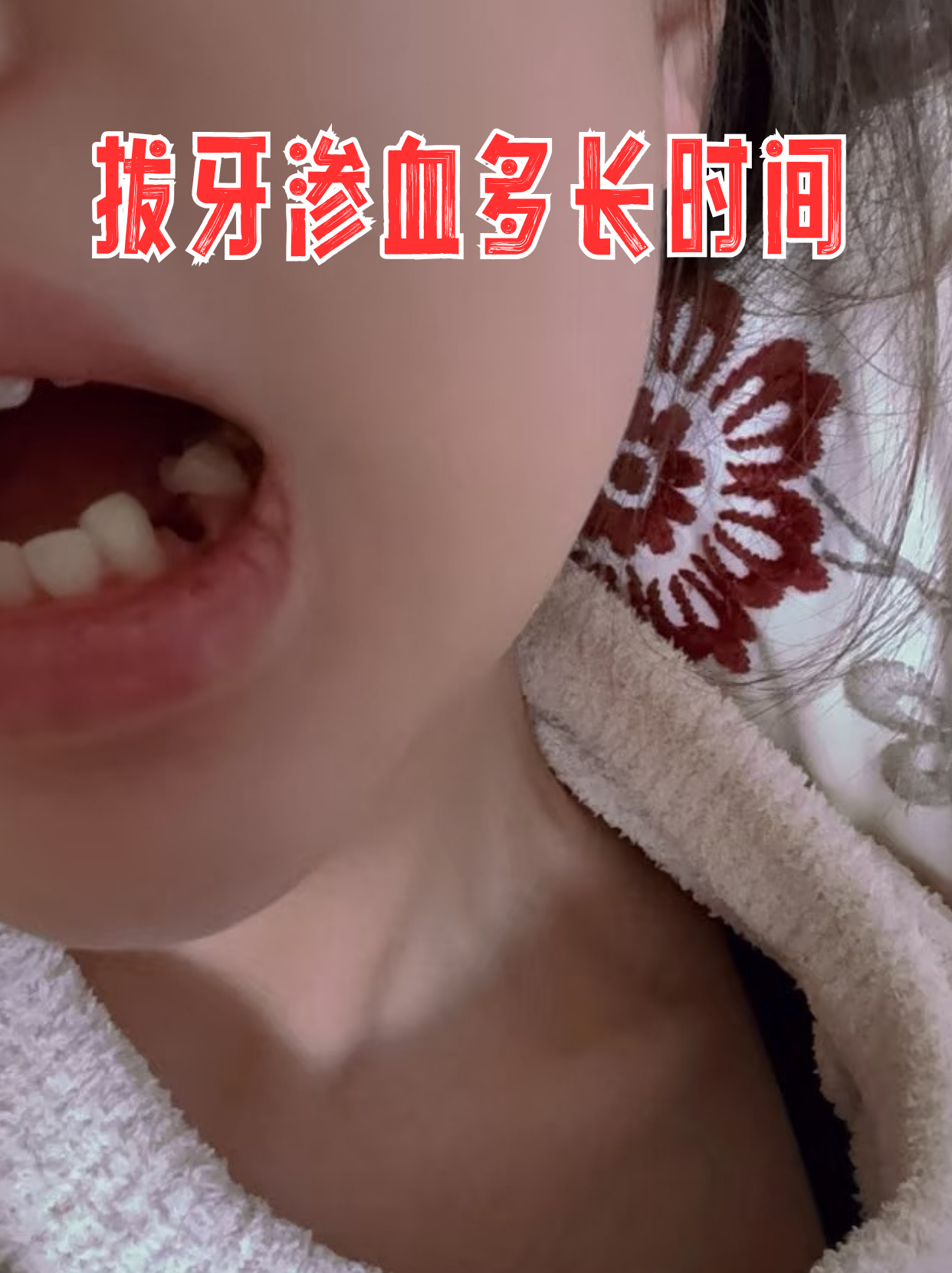 拔智齿后第二天血凝块变色了