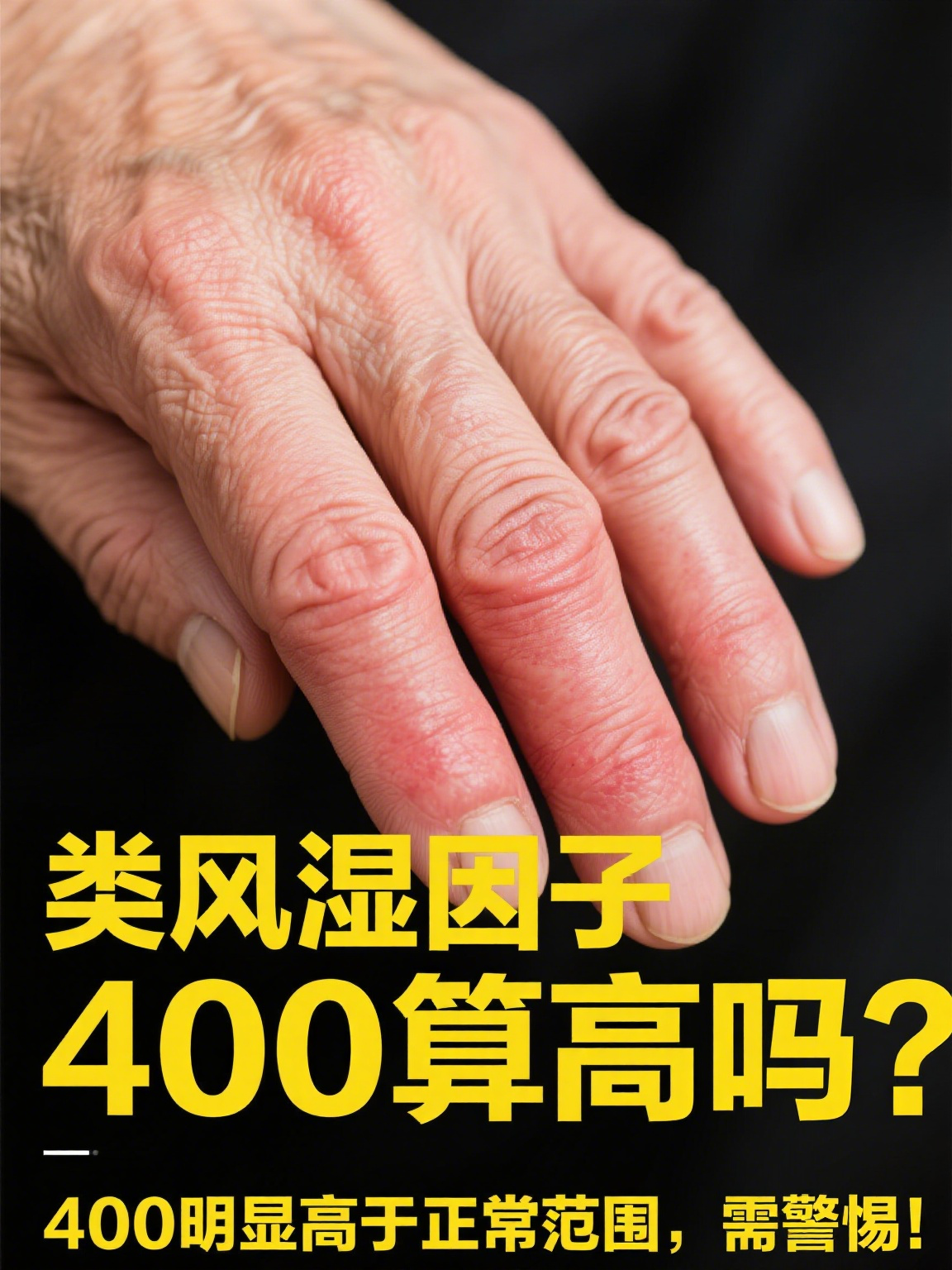 类风湿因子正常值是多少?