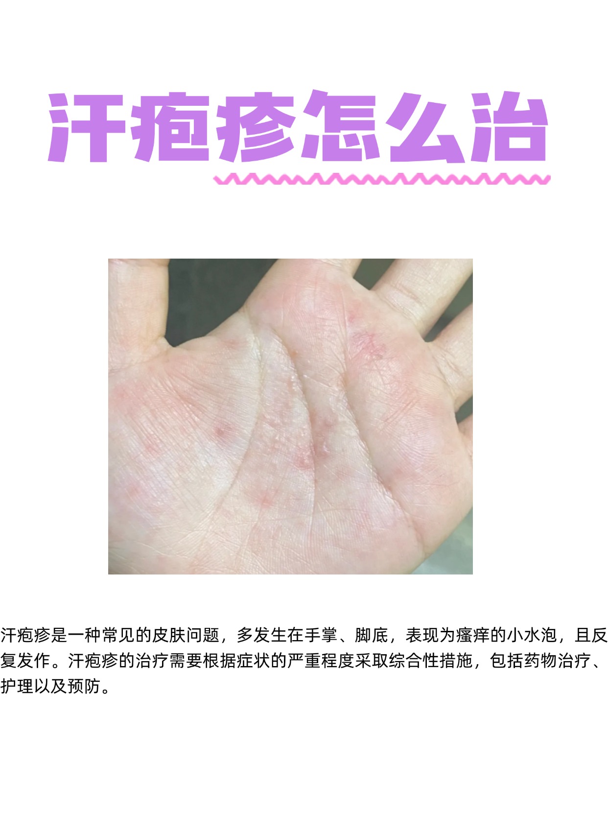 多汗症怎样治疗