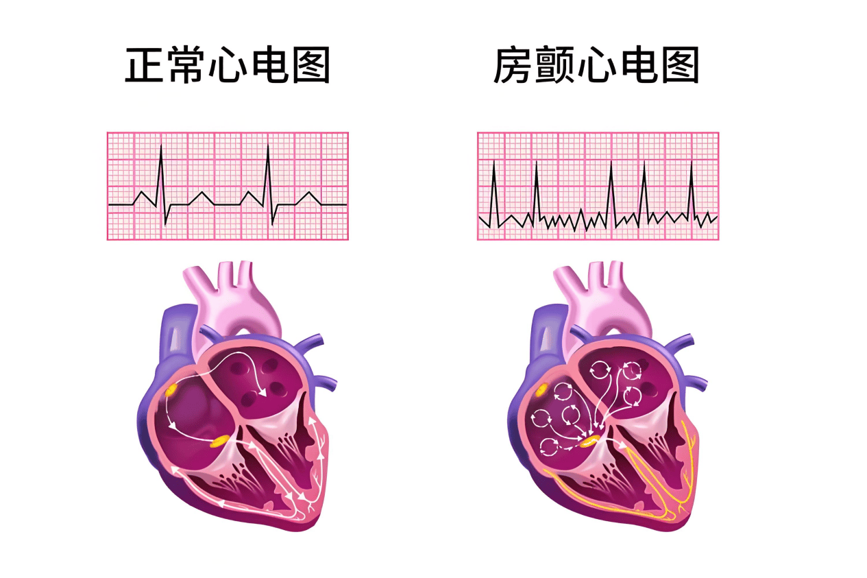 房颤心电图3大特点是什么