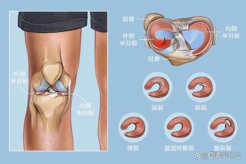 韧带撕裂自己会愈合吗