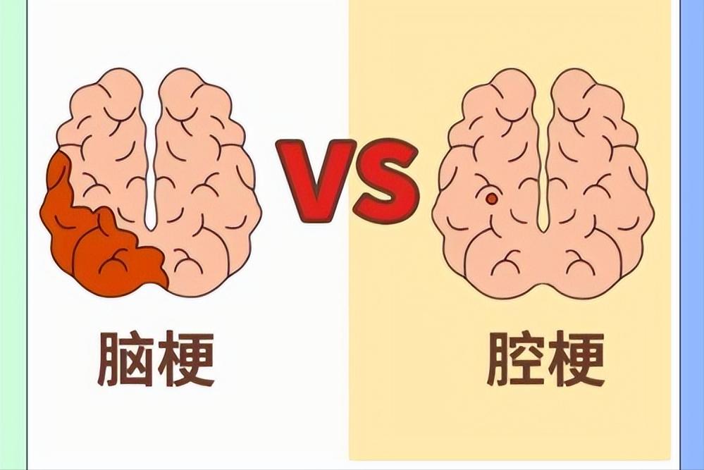 腔梗怎么治疗