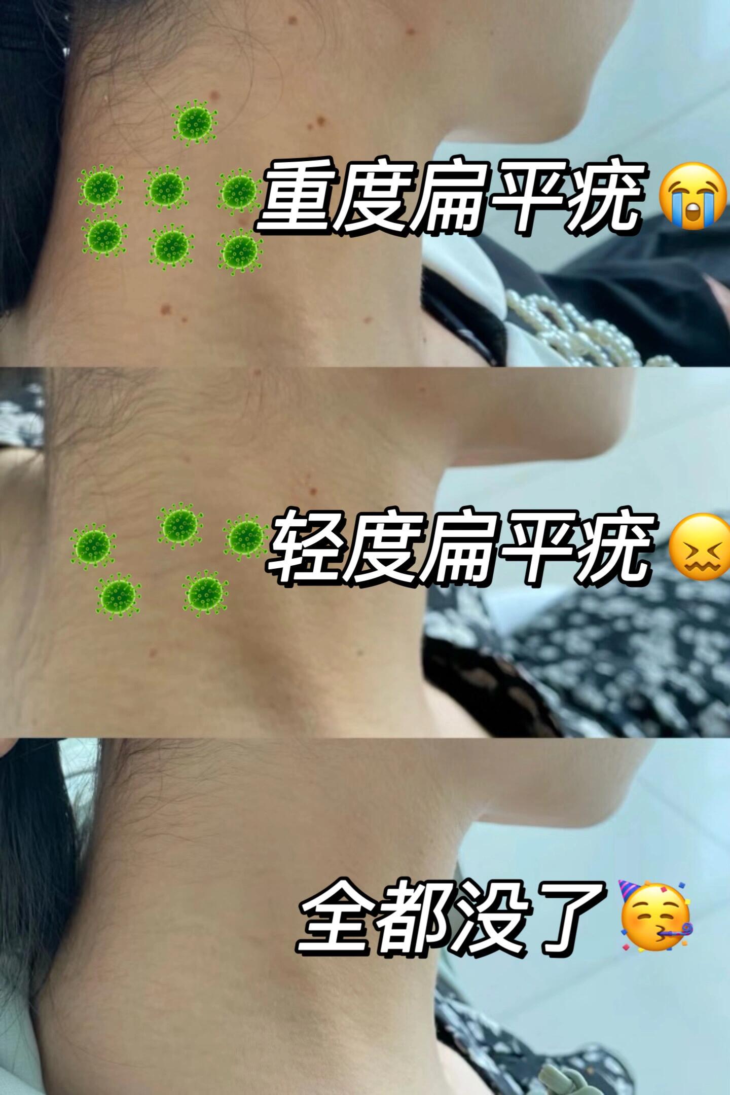 扁平疣是什么样子的?