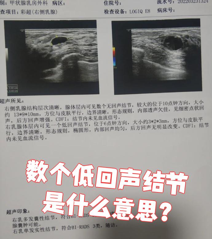甲状腺右叶低回声结节是什么意思?