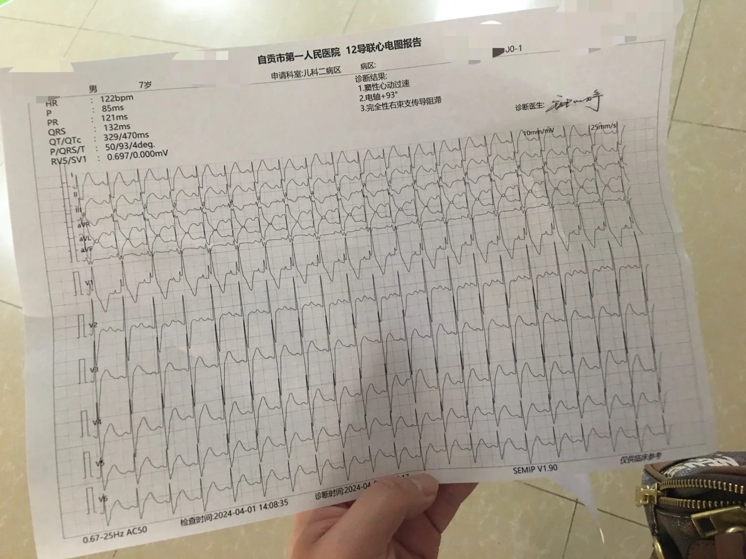 不完全性右束支传导阻滞严重吗