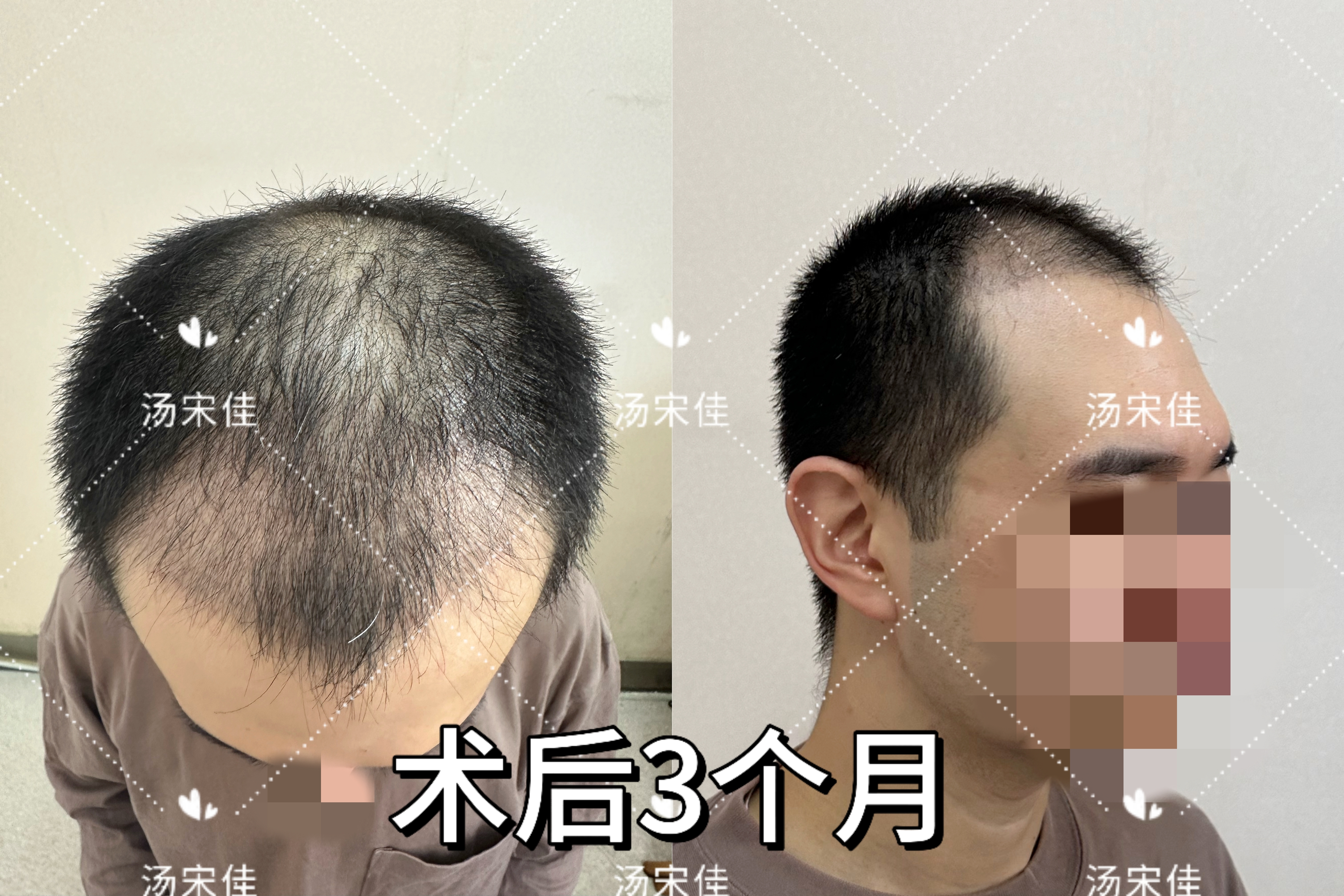 种植发际线的危害有哪些呢