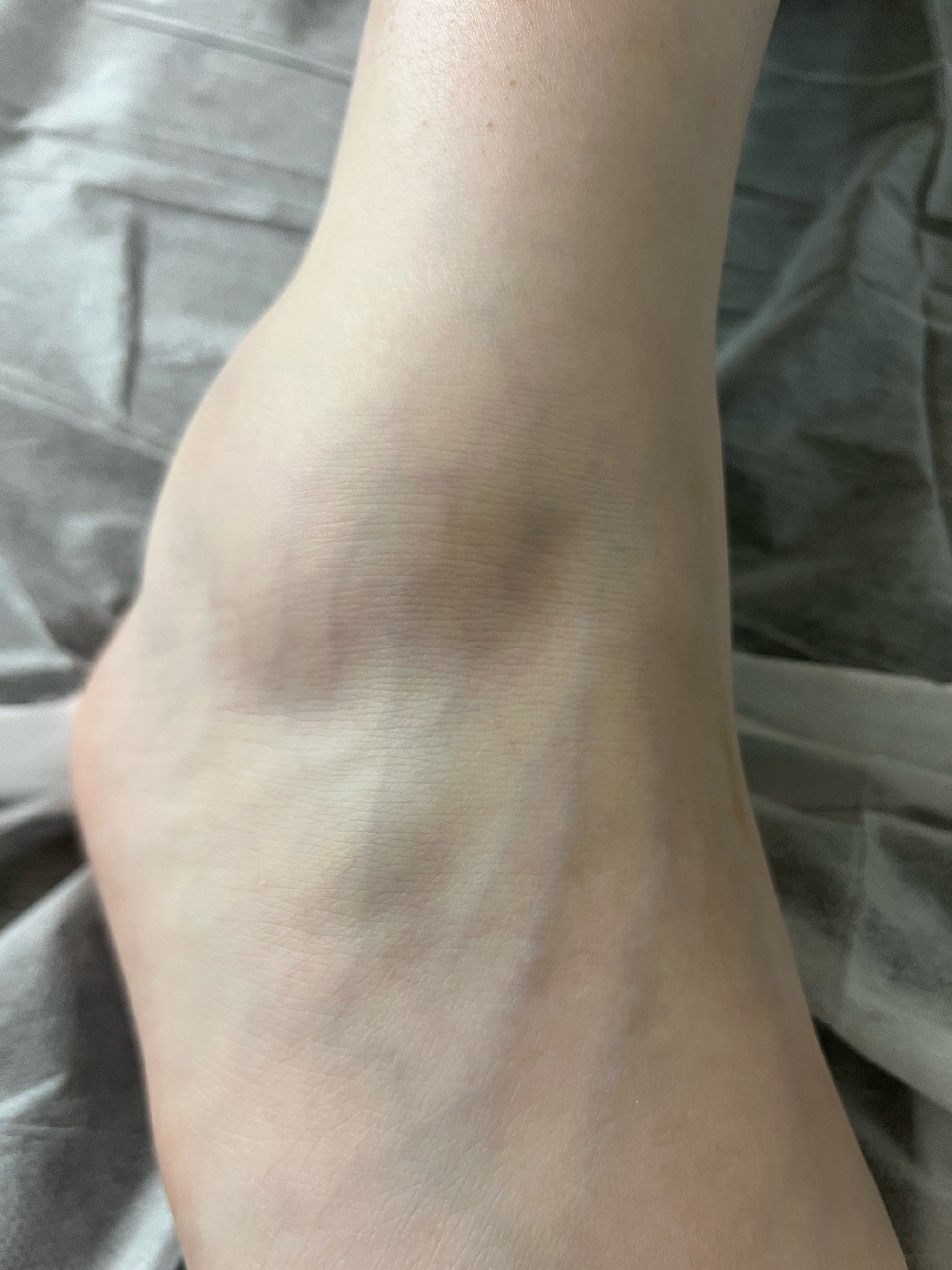 为什么脚踝突然浮肿?