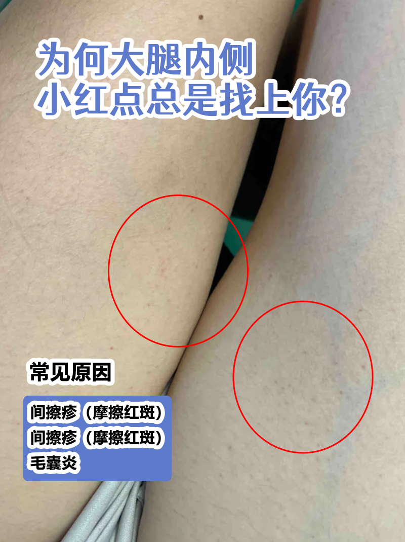 大腿内侧红疙瘩瘙痒怎么办怎么回事
