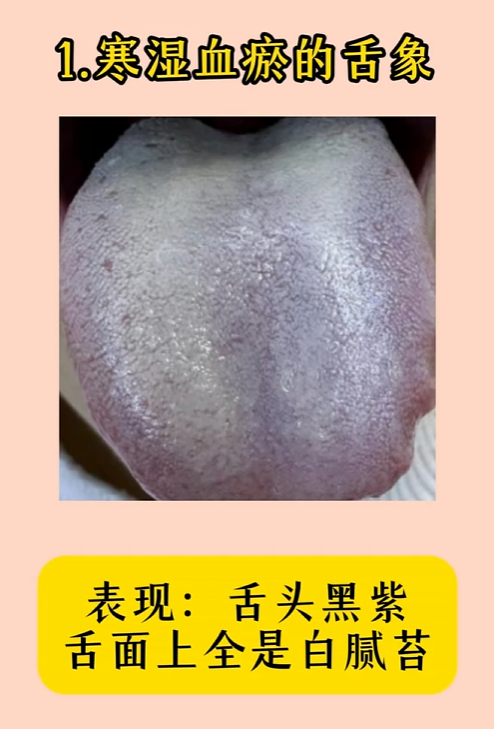 舌苔发黑是怎么回事