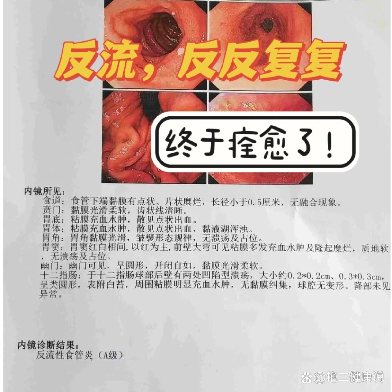 食管炎多久能好