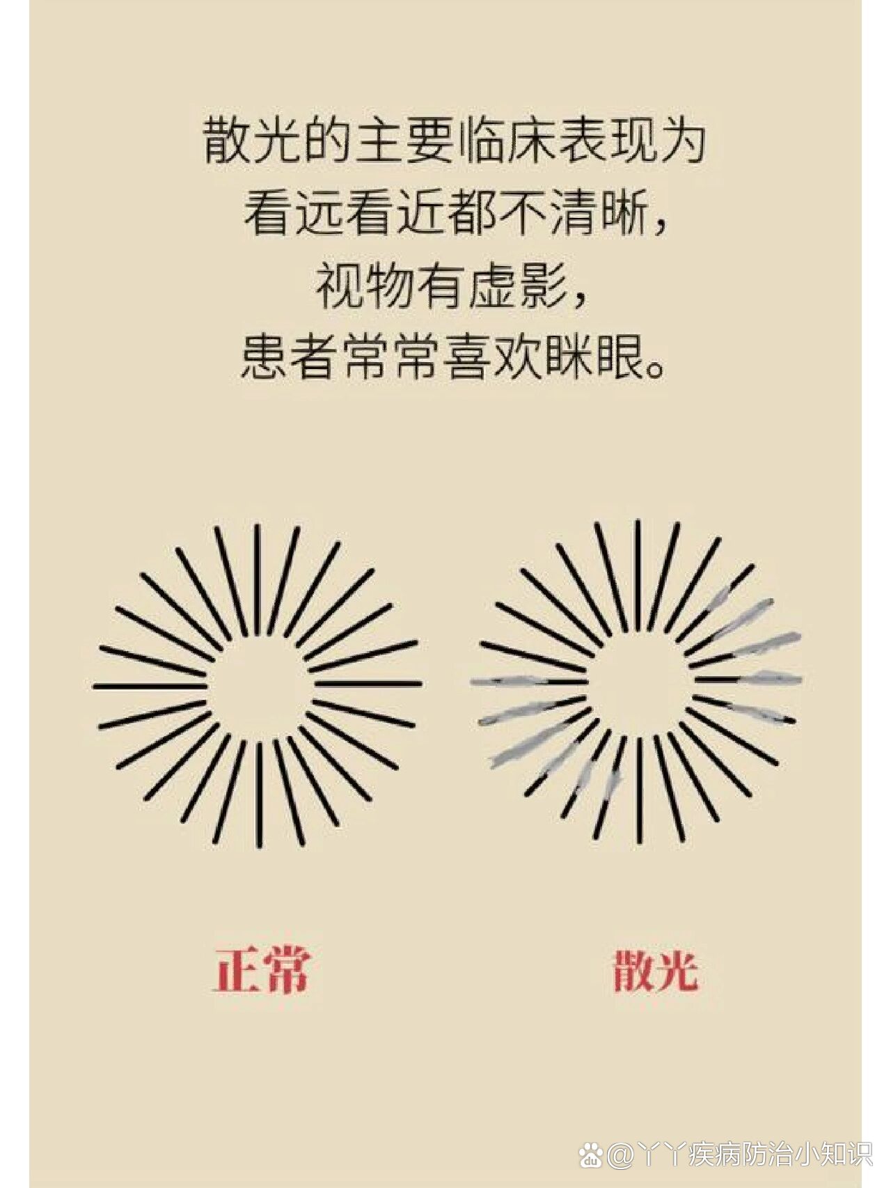 高度散光能治好吗