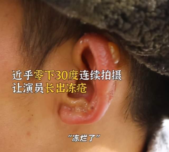 耳朵上长冻疮怎么办