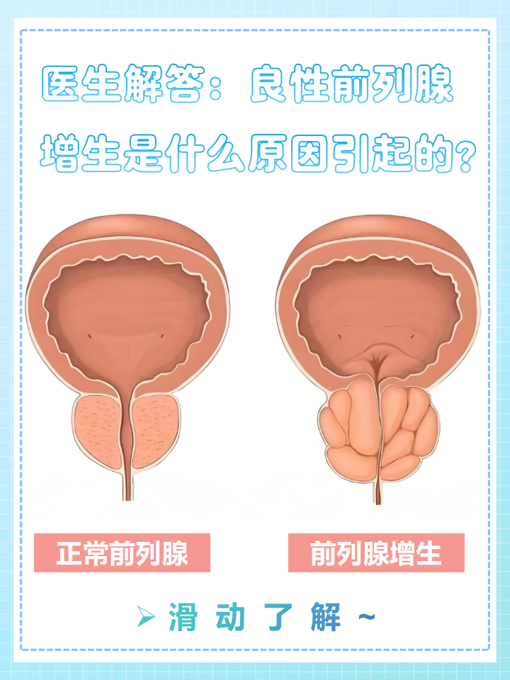 前列腺增生的临床表现
