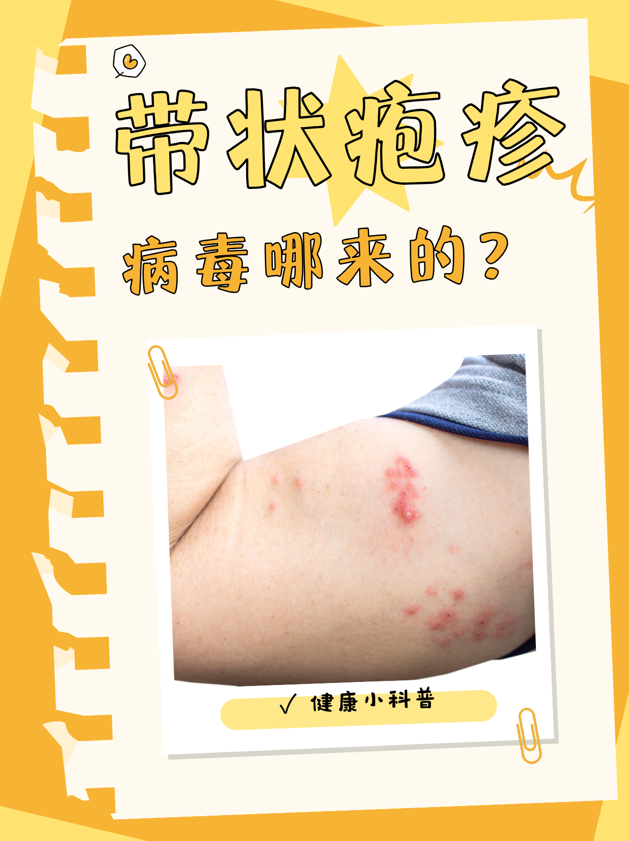 疱疹的传染途径是什么