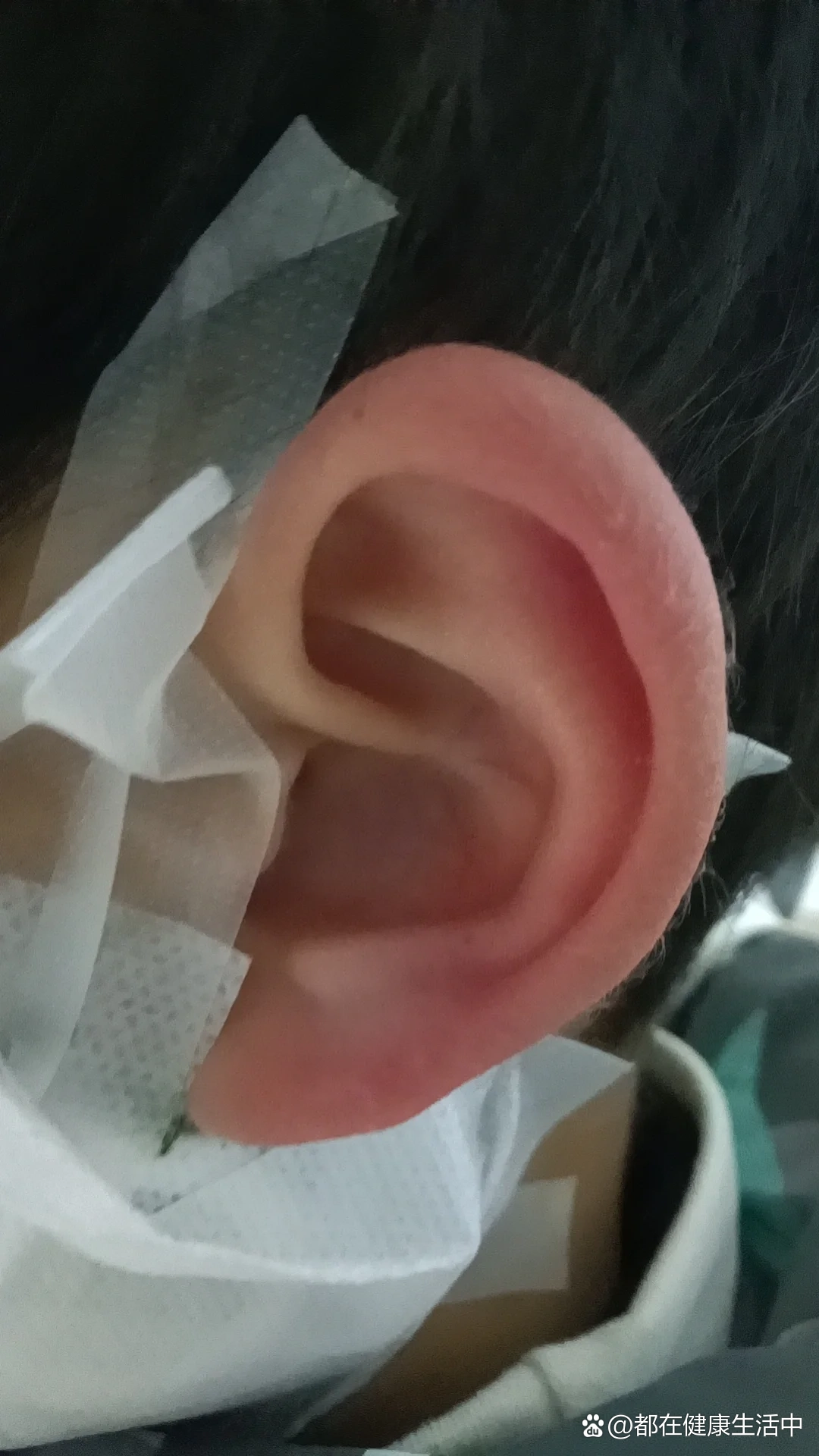 儿童腮腺炎